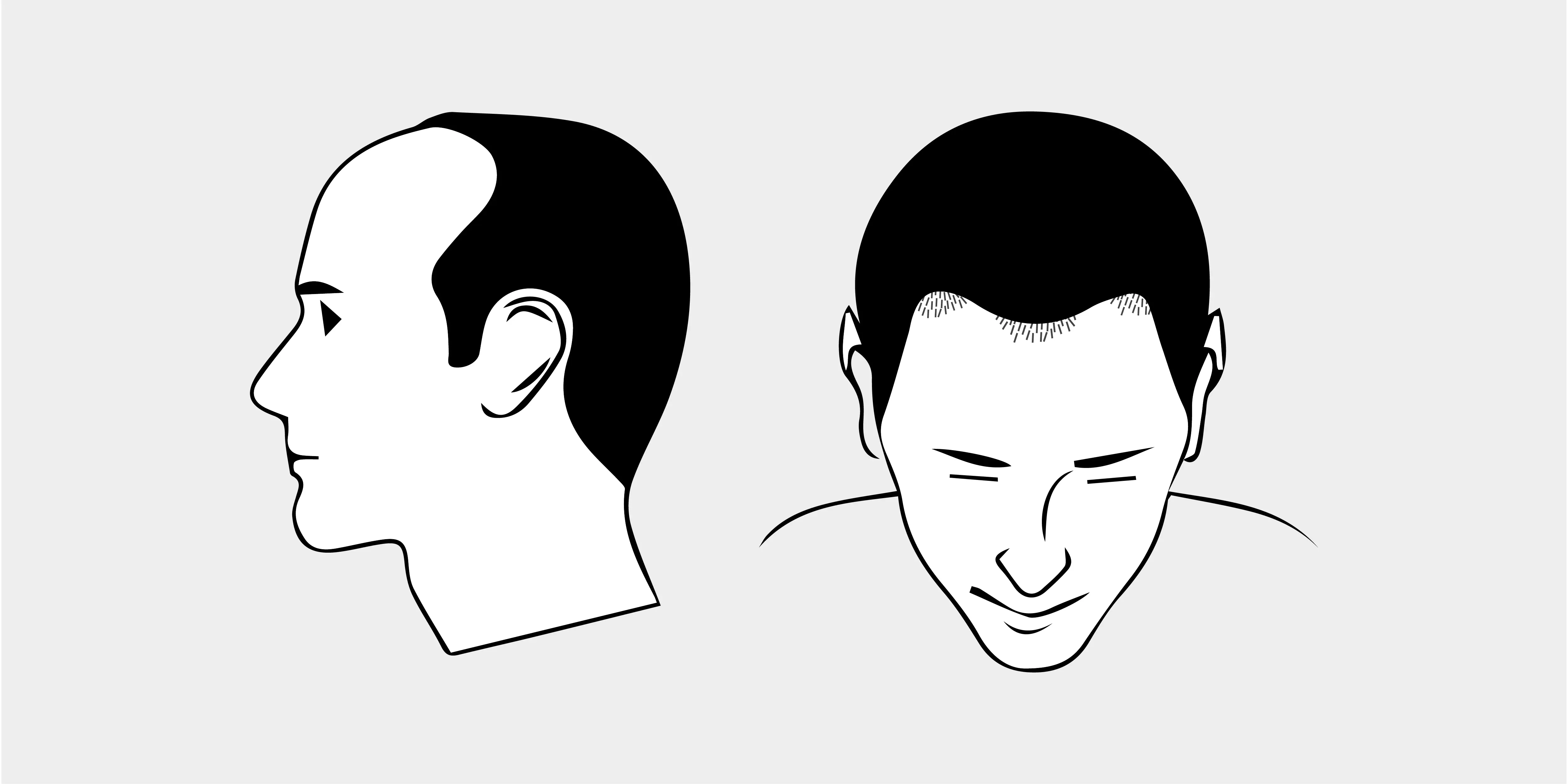 The Norwood Scale