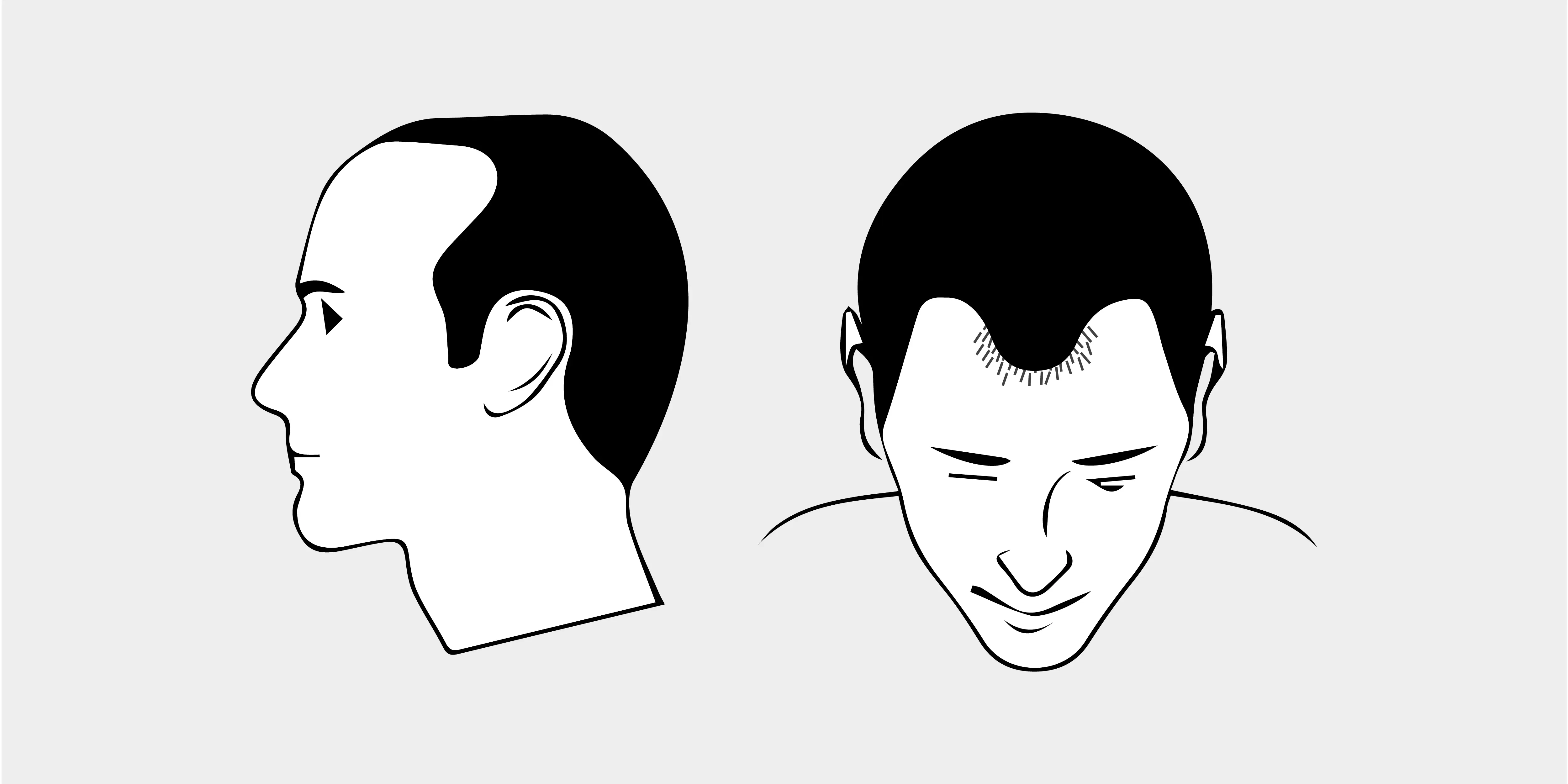 The Norwood Scale
