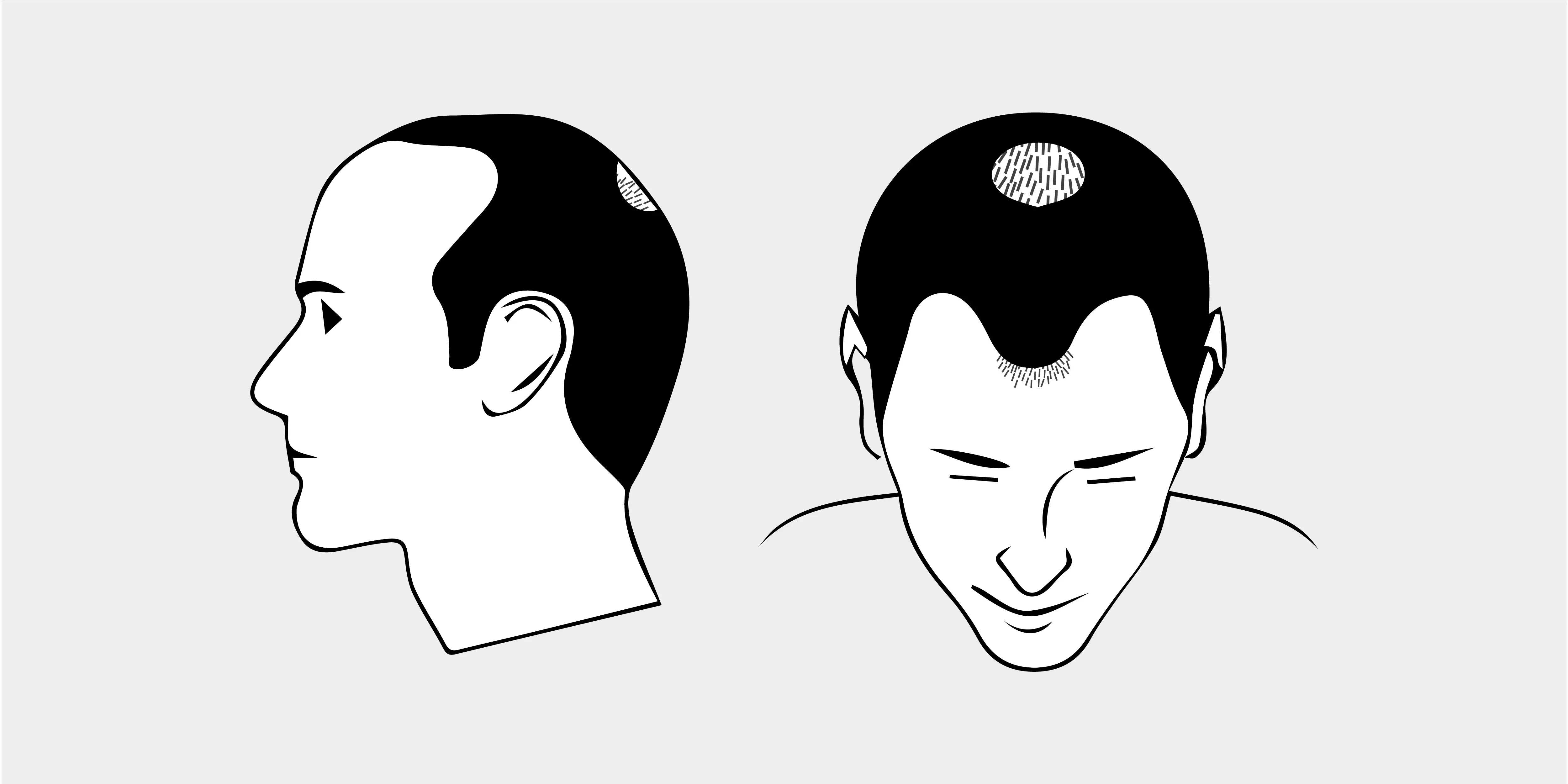The Norwood Scale