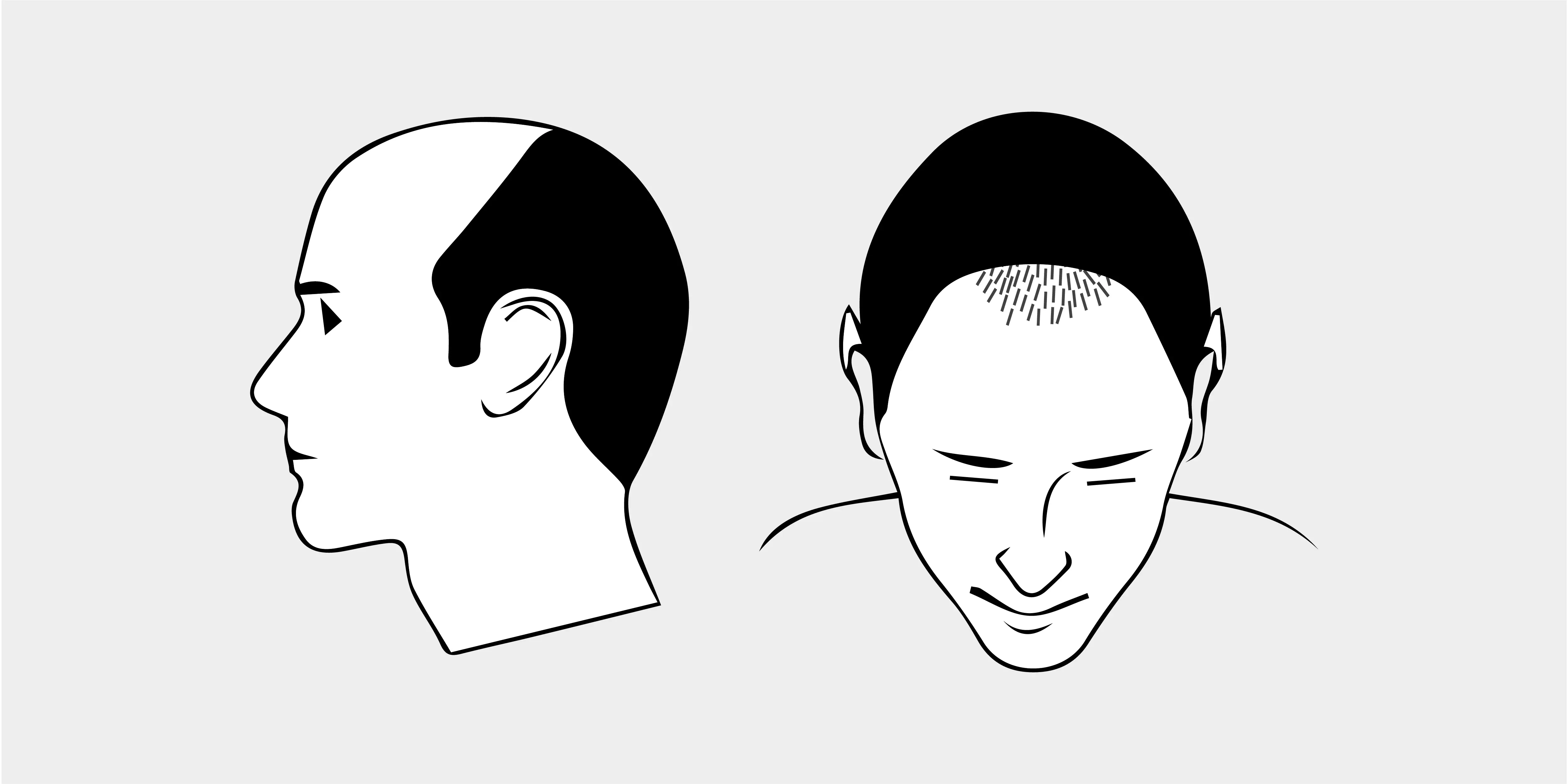 The Norwood Scale