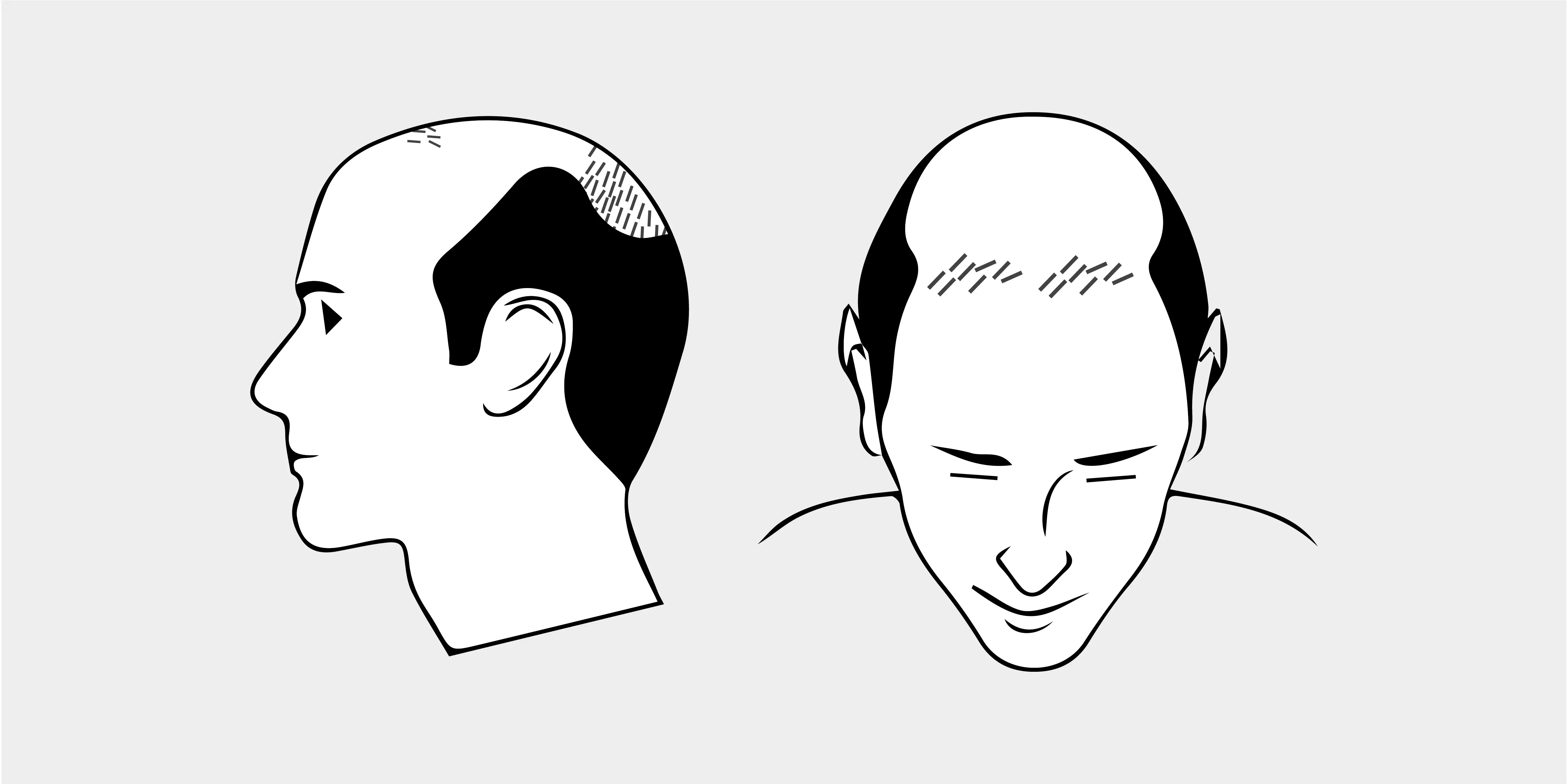 The Norwood Scale