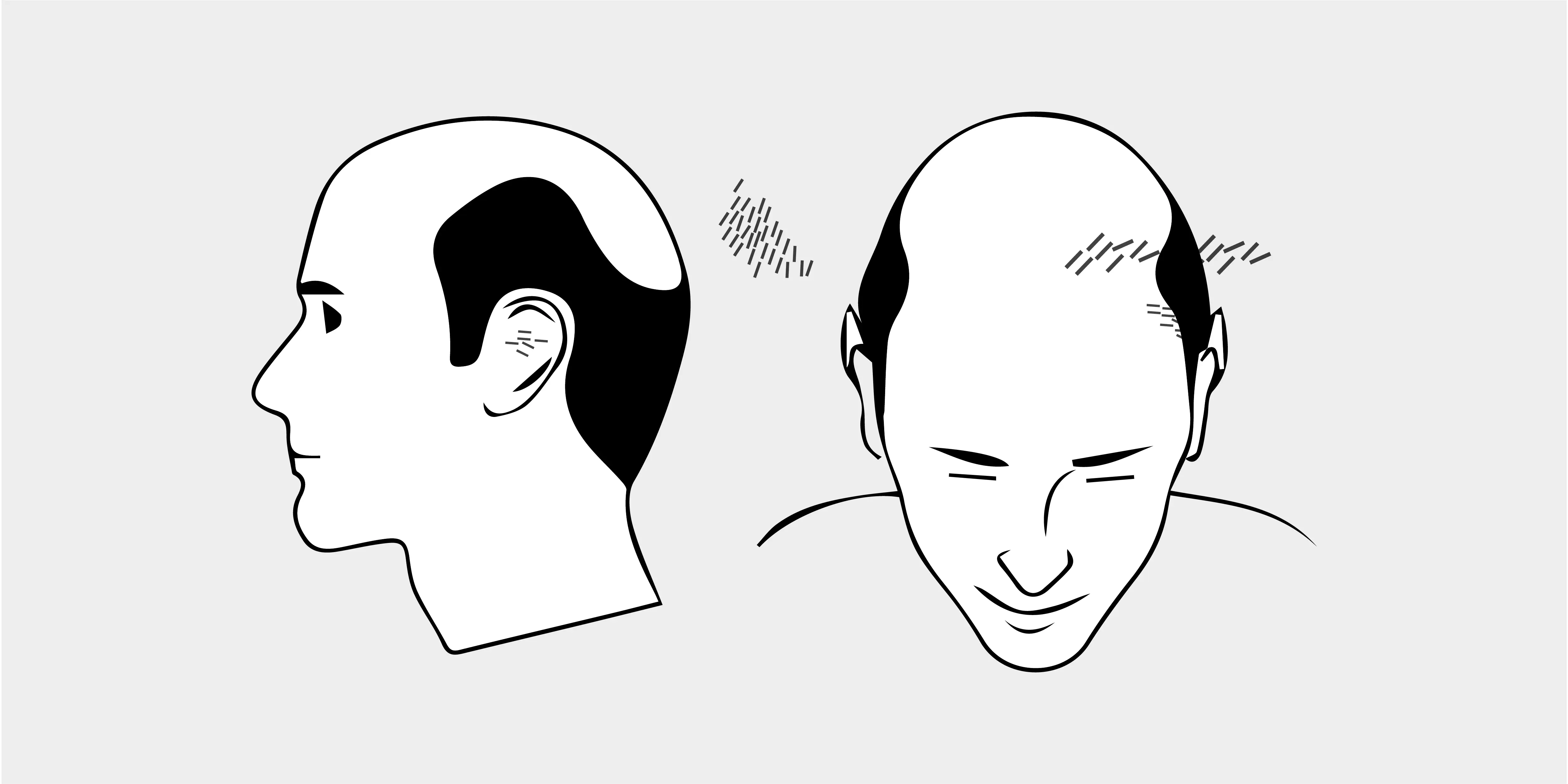 The Norwood Scale