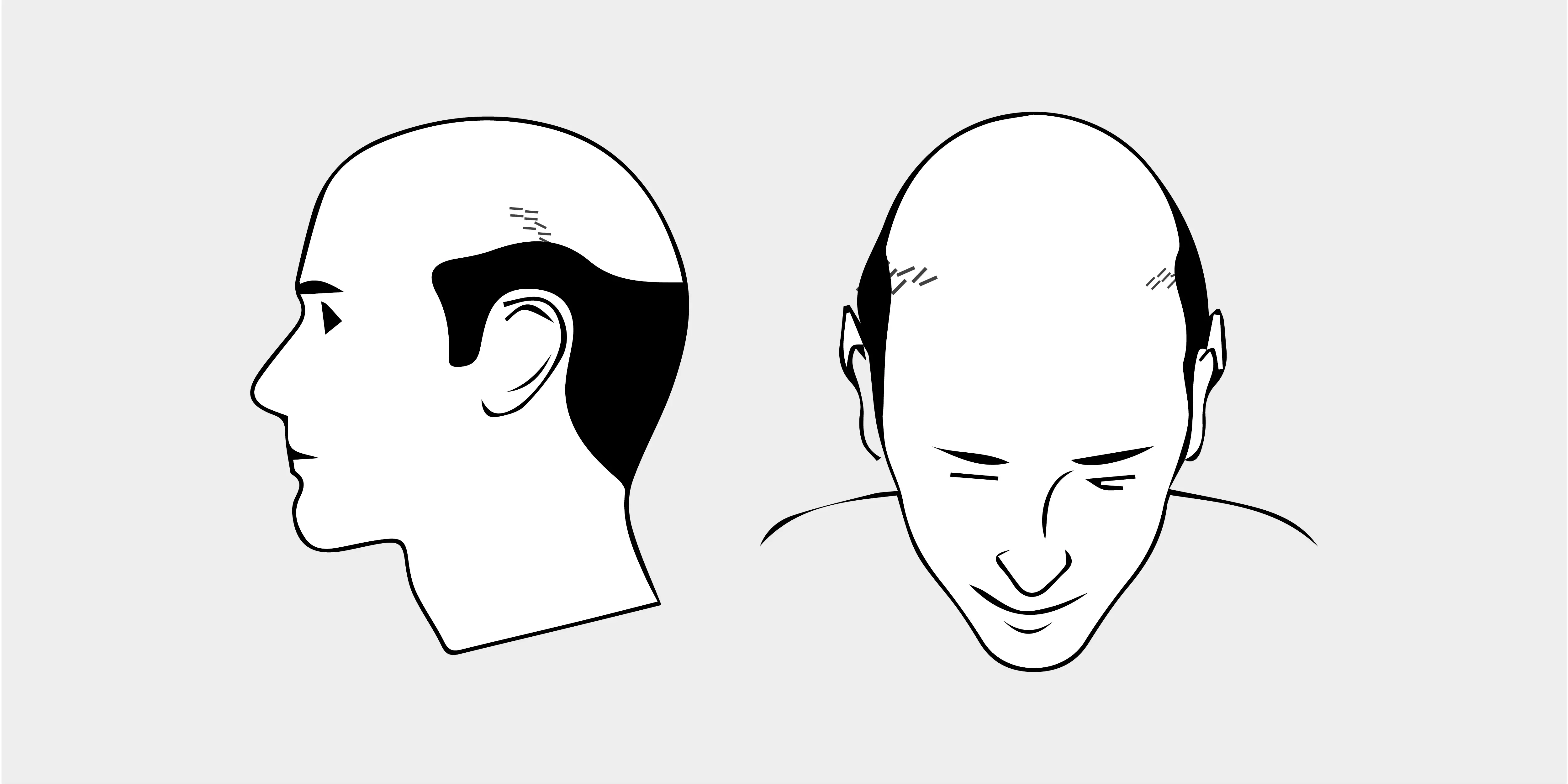 The Norwood Scale
