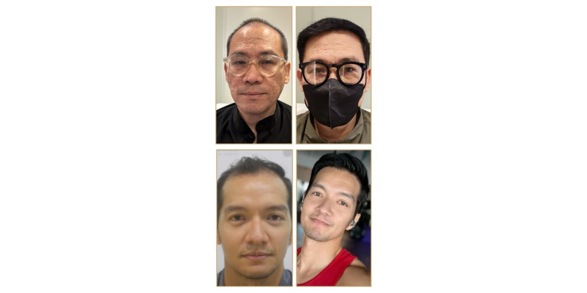 before and after photos after a hair transplant