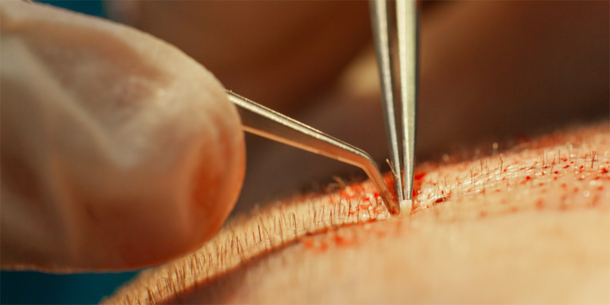 An image of a hair graft being transplanted on the head