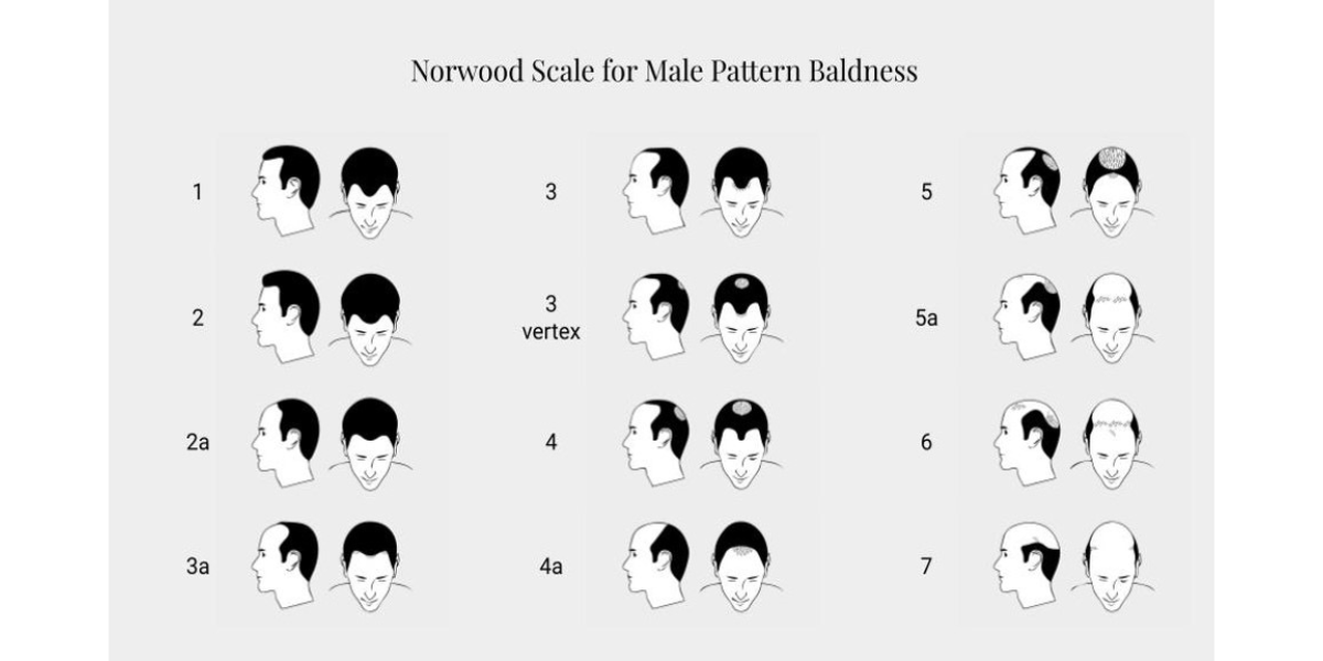 Norwood Scale for Male Pattern Baldness