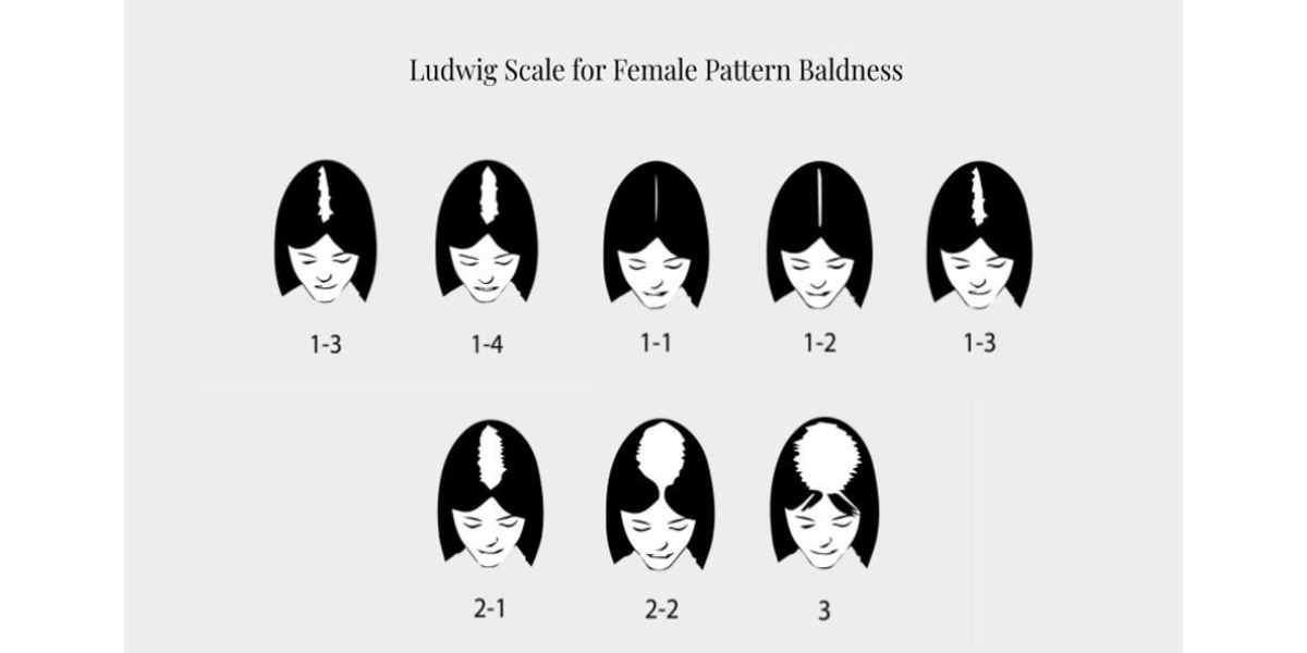 Ludwig Scale for Female Pattern Baldness