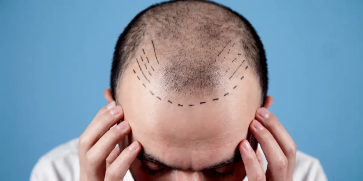 Are Hair Transplants Permanent?