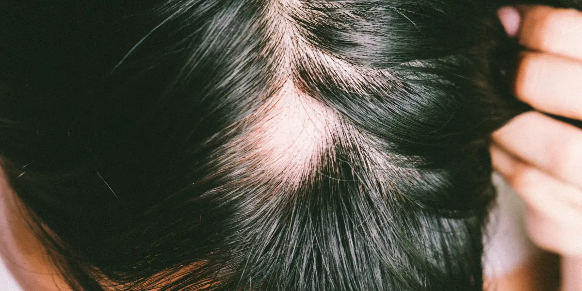 Balding in patches? It could be Alopecia Areata.