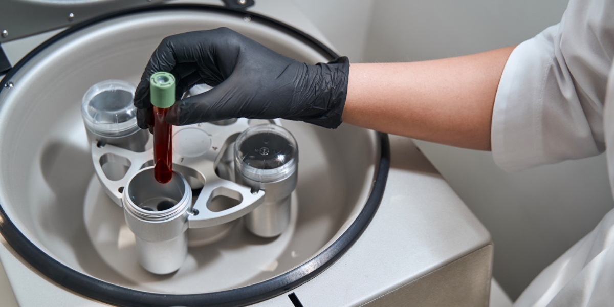 Platelet Rich Plasma for Hair Loss