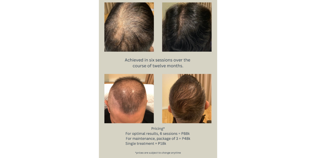 Platelet Mesotherapy results using PRP
