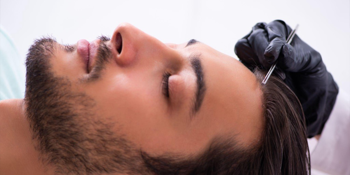 Man getting a hair transplant