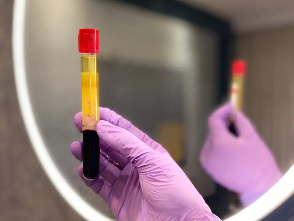 PRP using growth factors to improve skin tone and medical treatment for hair loss