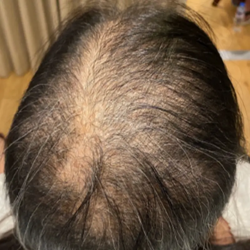 Collagen mesotherapy is used to thicken hair and to treat hair fall for men and women