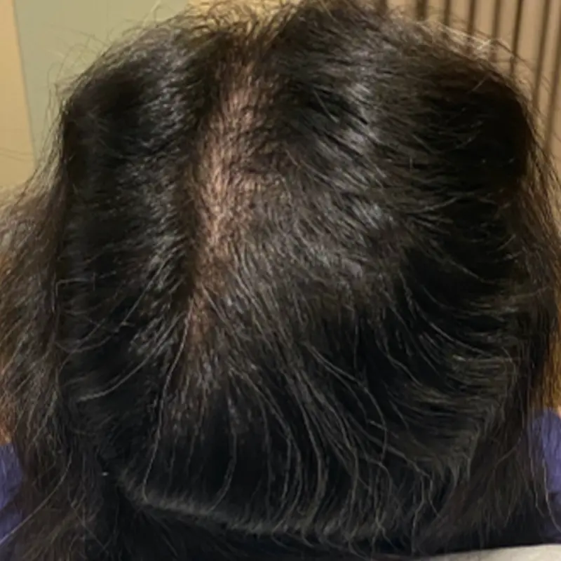 Collagen mesotherapy is a medical procedure for thicker hair and treating alopecia