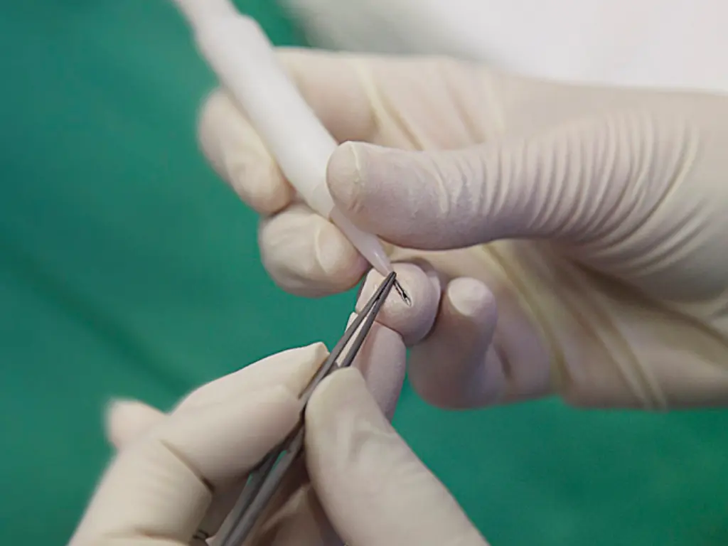 Direct Hair Implantation technique of implanting hair follicles with a choi pen