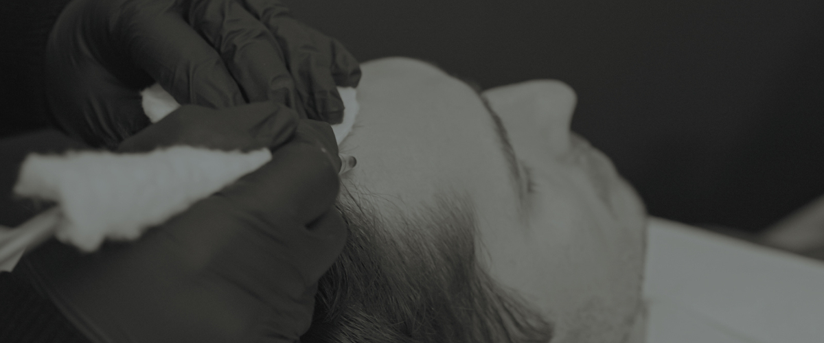 Clinique De Paris - Scalp Micropigmentation or hair tattooing is a treatment for balding or hair loss